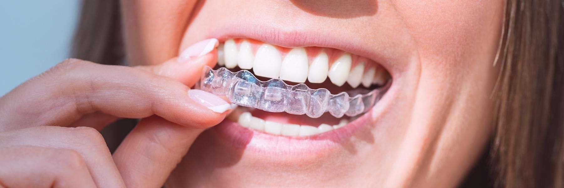 Lady Gets Braces Fixed 