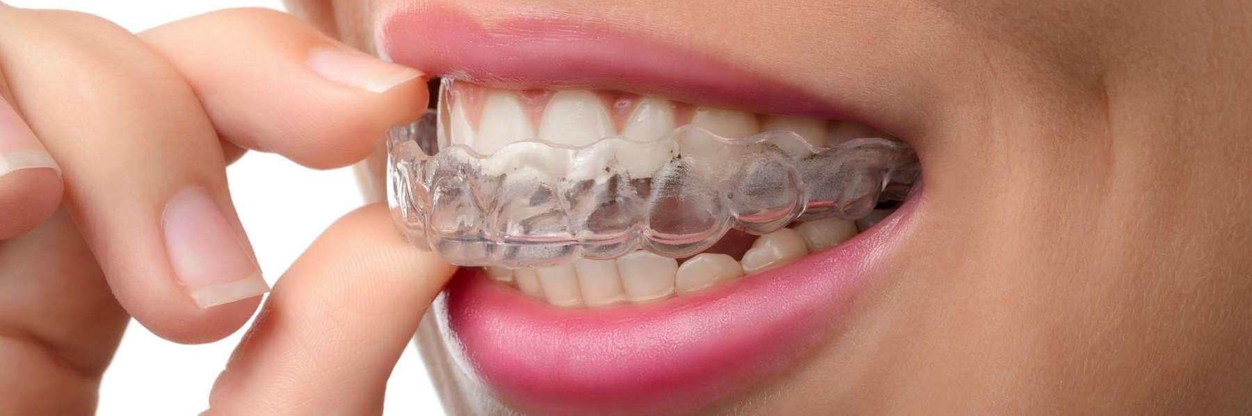 A close-up of a woman with clear braces, smiling brightly and showing her teeth.