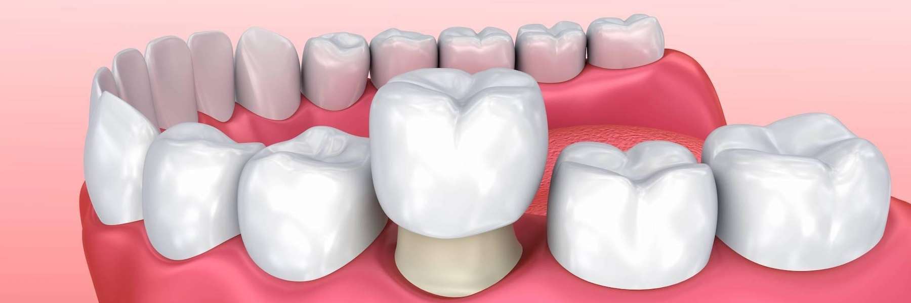 Close-up of a dental implant with crown, highlighting a realistic tooth replacement.