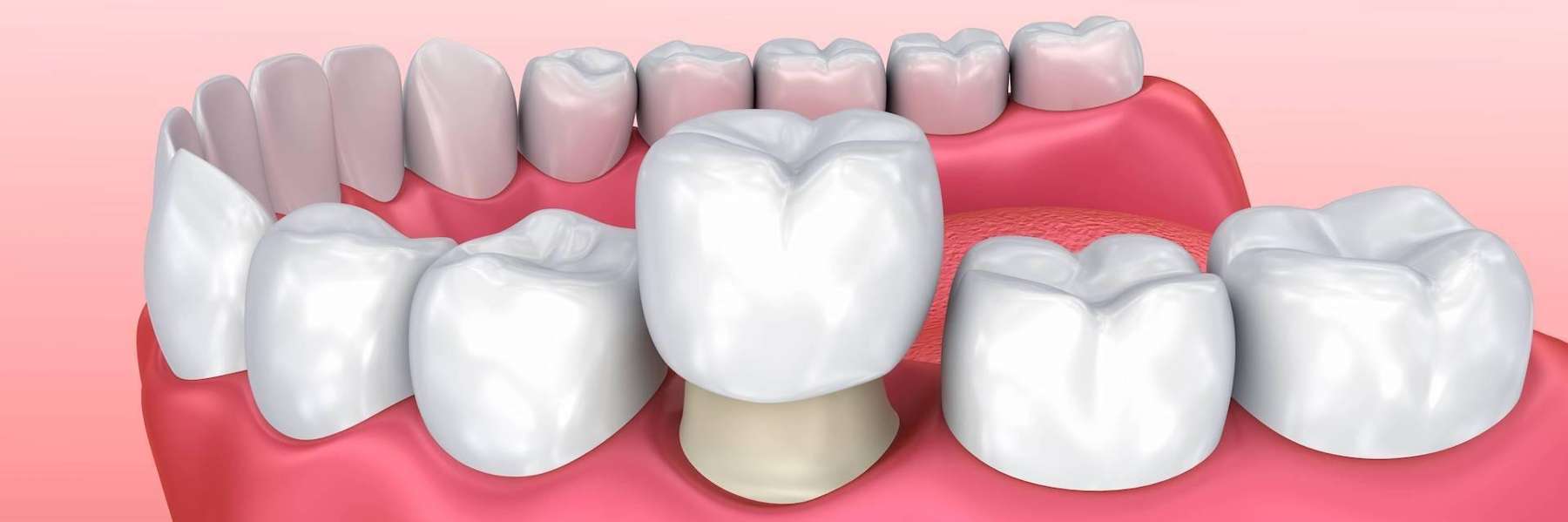 A tooth featuring a crown and tooth, showcasing the restoration of a natural smile with dental crown