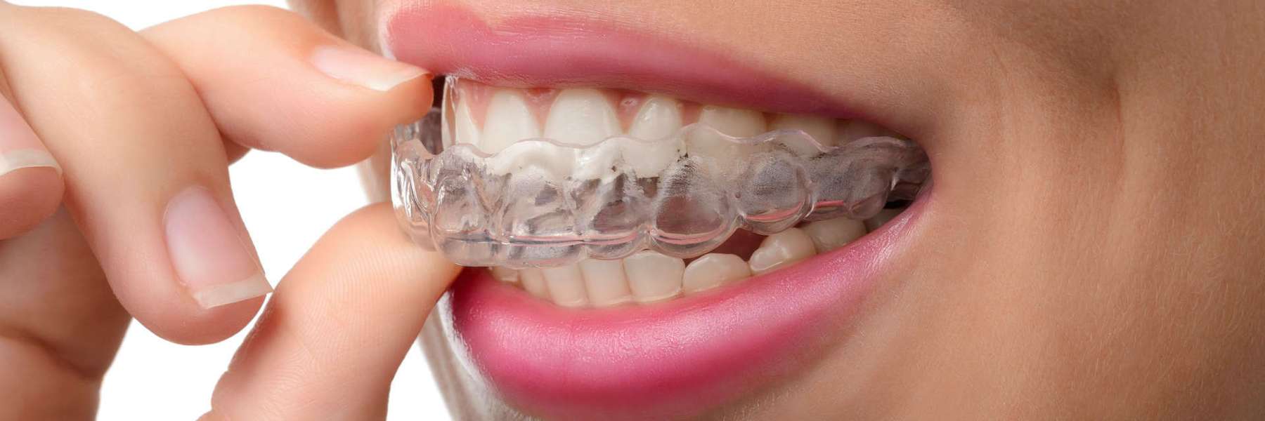 Close-up of a person’s mouth inserting a clear Invisalign® aligner, illustrating proper aftercare