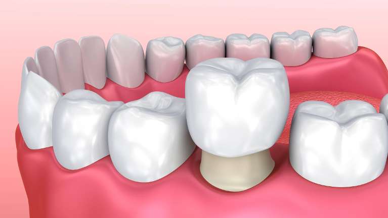 close up of dental crown | dental crowns foothills ranch