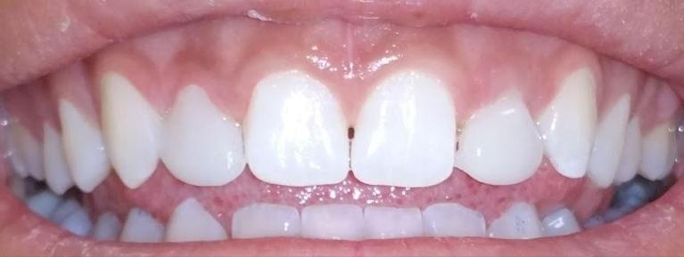 Direct-Composite-Veneers-After-Image