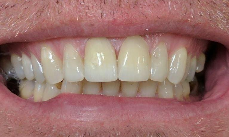 Esthetic-Crowns-After-Image