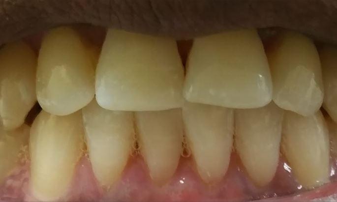 Front teeth after dental crown procedure in Lake Forest, CA