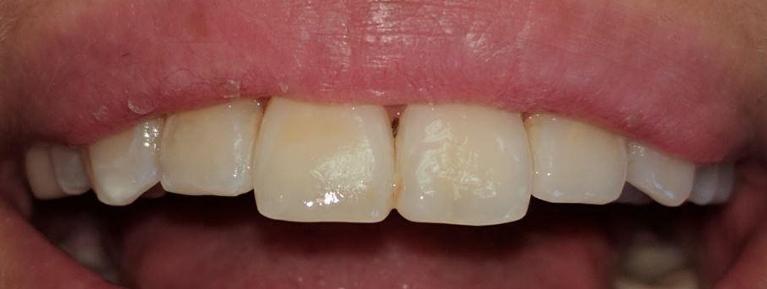 Front teeth after dental crown procedure in Foothill Ranch