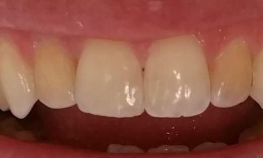 Mesioincisofacial-Composite-After-Image