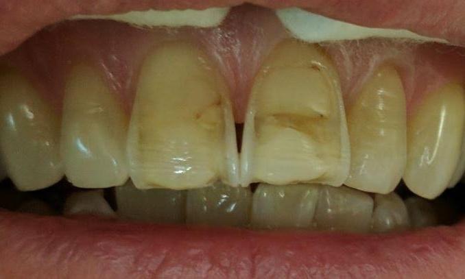 Esthetic-Crowns-Before-Image
