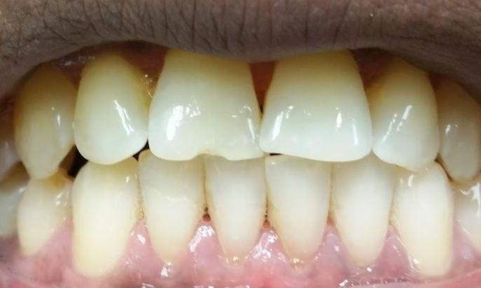 Chipped front teeth before dental crowns in Lake Forest, CA