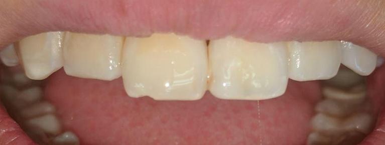 Chipped front tooth before dental crowns in Foothill Ranch